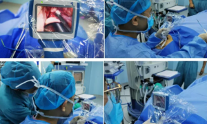 延安市中医医院耳鼻咽喉头颈外科引进弧形可视喉镜下会厌囊肿切除术