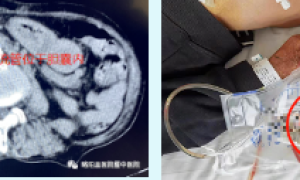 略阳县医院暨中医院首例在CT引导下经皮经肝胆囊造瘘术(PTGD)成功开展