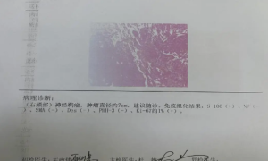 延安大学附属医院：颌面深部肿瘤隐藏多年 巧施术面容保留完整