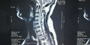 3201医院成功开展陕南首例颈椎微创技术脊柱内镜下颈后路髓核摘除术