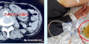 略阳县医院暨中医院首例在CT引导下经皮经肝胆囊造瘘术(PTGD)成功开展