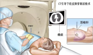 延安市中医医院：开展复杂高难度CT引导下经皮肺穿刺活检术